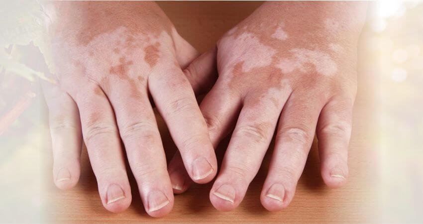 leucoderma